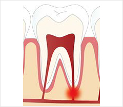 歯根の病気