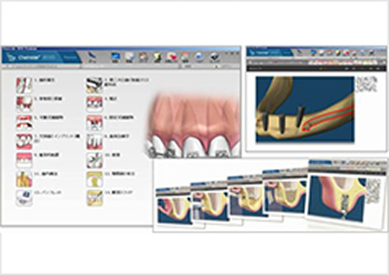 コンサルトプロ（3D-CG治療説明）
