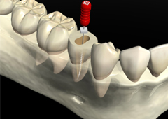 根管治療とは