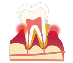 歯周病