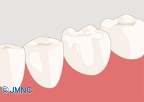 セラミックインレー
