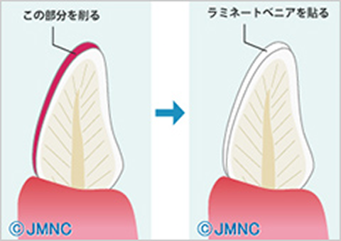 ラミネートべニア